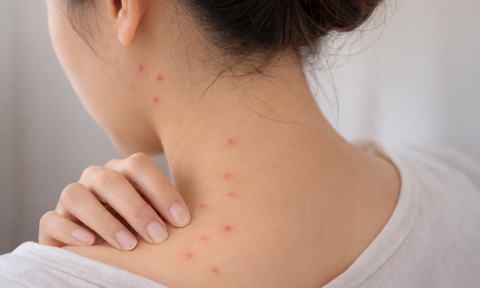 Các giai đoạn sốt xuất huyết