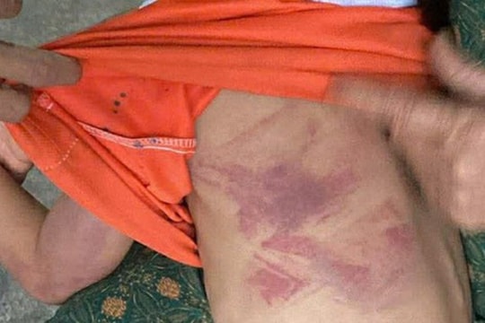 Bé gái lớp 2 bị bạn cùng lớp dùng thước đánh thâm tím người vì không cho kẹo