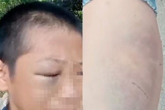 Xôn xao clip bé trai mắt bầm tím, khóc kêu cứu vì nhiều lần bị đánh đập khi ở cùng bố và vợ mới
