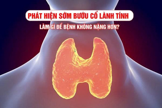 Vì sao cần phát hiện sớm bướu cổ lành tính và cách kiểm soát bệnh?