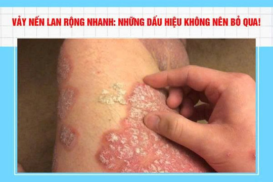 Vảy nến lan rộng: Những dấu hiệu không nên bỏ qua!