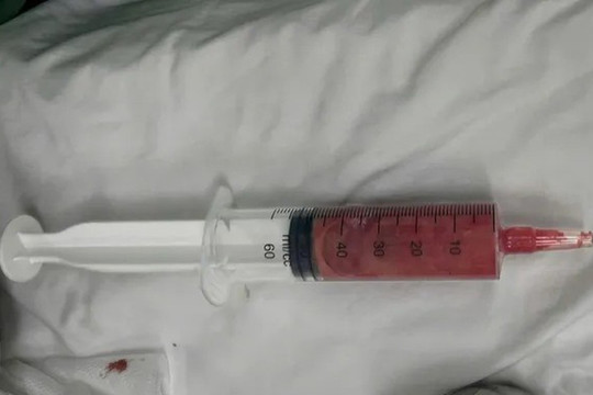 Bệnh viện Trung ương Quân đội 108 cảnh báo những người tiêm filler 5-10 năm trước