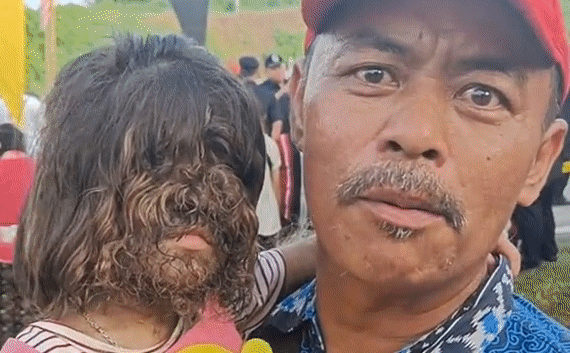 Quốc vương Malaysia chụp ảnh với em bé ‘người sói’